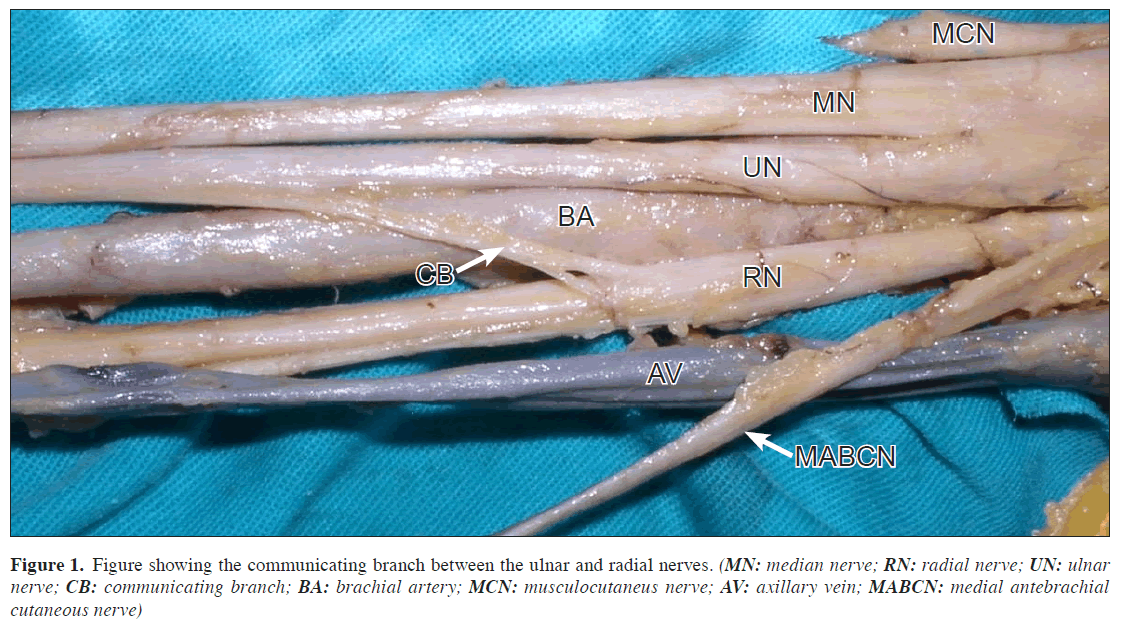 anatomical-variations-radial-nerves