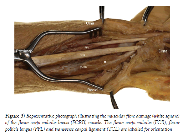 anatomical-variations-radialis-brevis