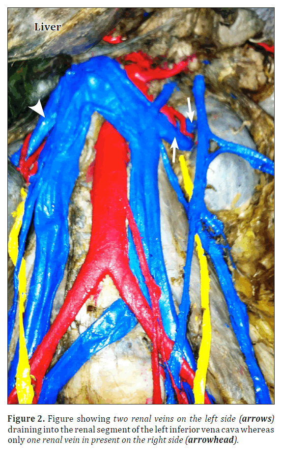 anatomical-variations-renal-segment