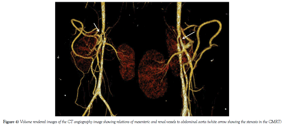 anatomical-variations-renal-vessels