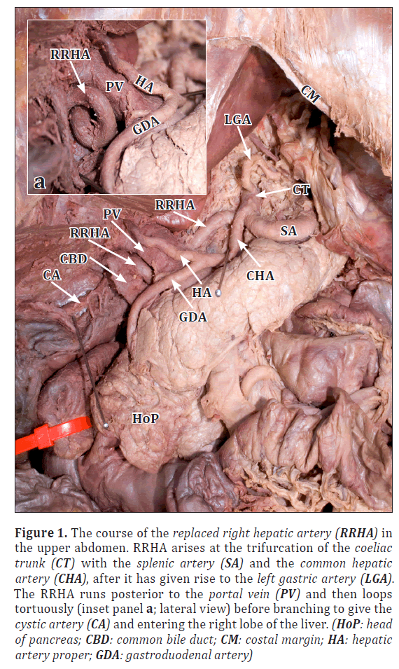 anatomical-variations-replaced-right