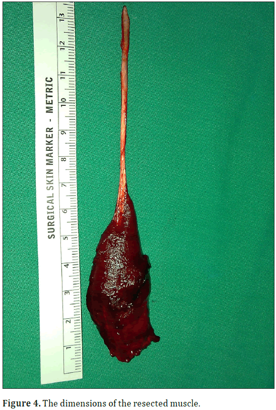 anatomical-variations-resected-muscle
