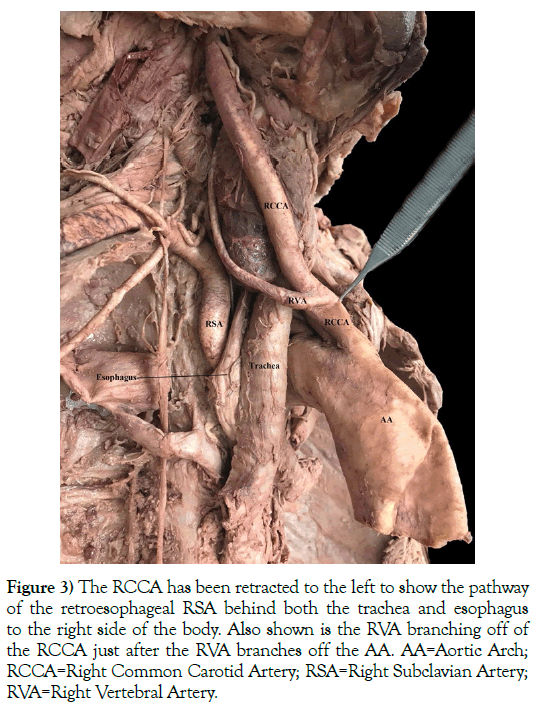 anatomical-variations-retroesophageal