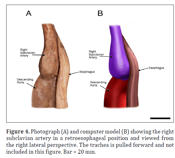 anatomical-variations-retroesophageal-position