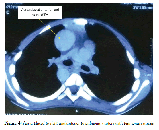 anatomical-variations-right-anterior