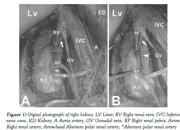 anatomical-variations-right-kidney