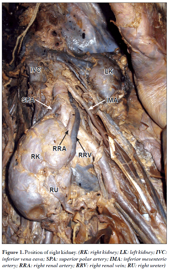 anatomical-variations-right-kidney
