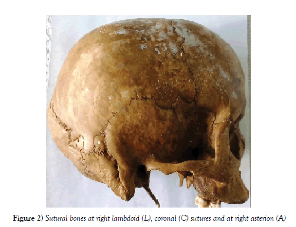 anatomical-variations-right-lambdoid