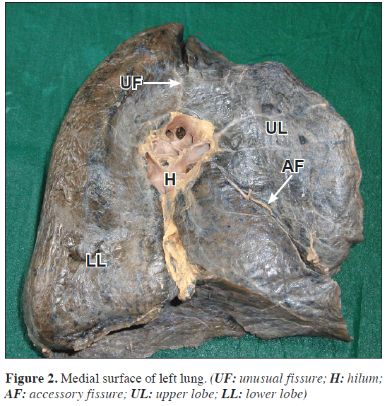 anatomical-variations-right-lung