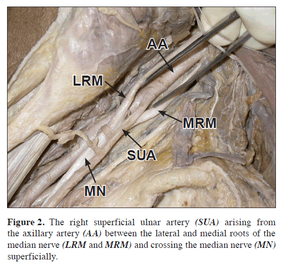 anatomical-variations-right-superficial