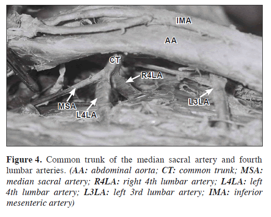 anatomical-variations-sacral-artery