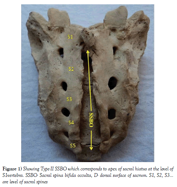 anatomical-variations-sacral-hiatus