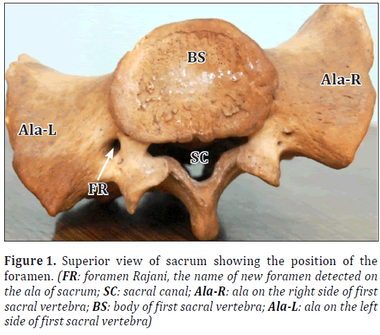 anatomical-variations-sacrum-foramen