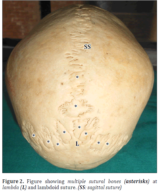 anatomical-variations-sagittal-suture