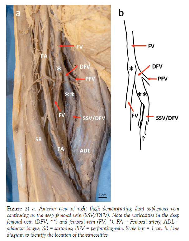 anatomical-variations-saphenous-vein