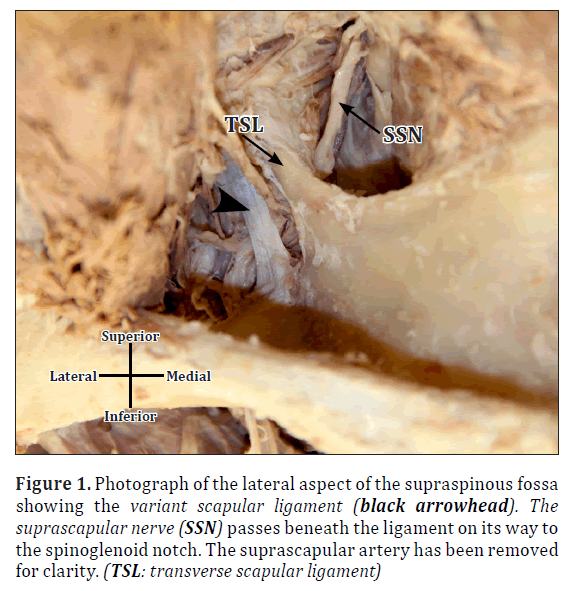 anatomical-variations-scapular-ligament