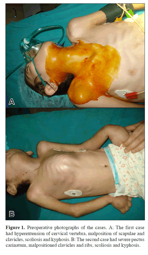 anatomical-variations-scoliosis-kyphosis