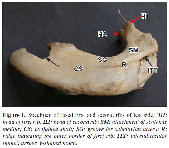 anatomical-variations-second-ribs