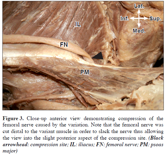 anatomical-variations-slight-muscle