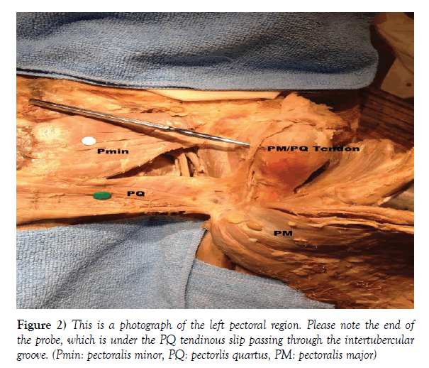 anatomical-variations-slip-passing