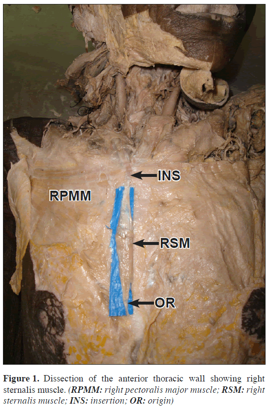 anatomical-variations-sternalis