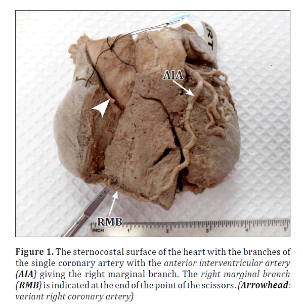 anatomical-variations-sternocostal-surface