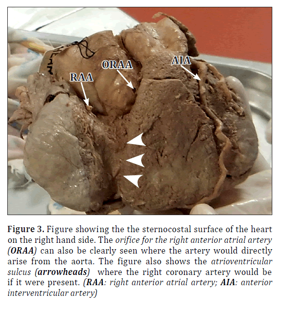 anatomical-variations-sternocostal-surface