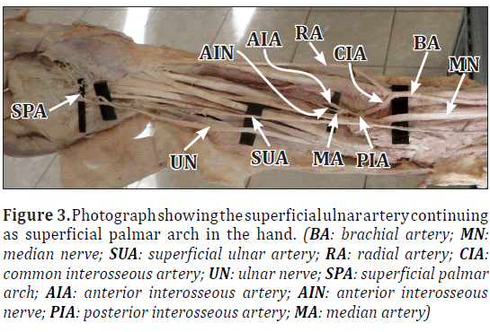 anatomical-variations-superficial-ulnar