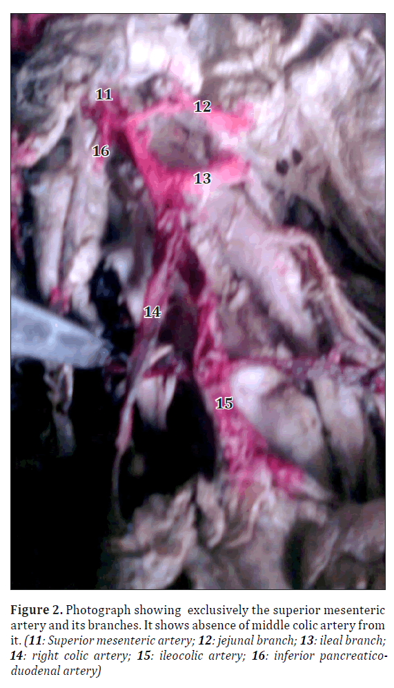 anatomical-variations-superior-mesenteric