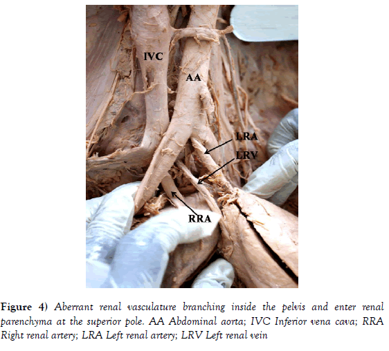 anatomical-variations-superior-pole