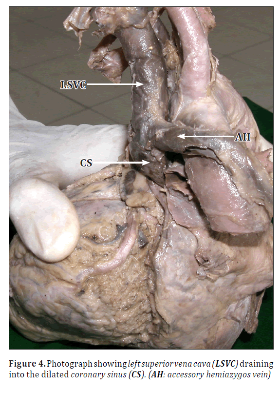 anatomical-variations-superior-vena