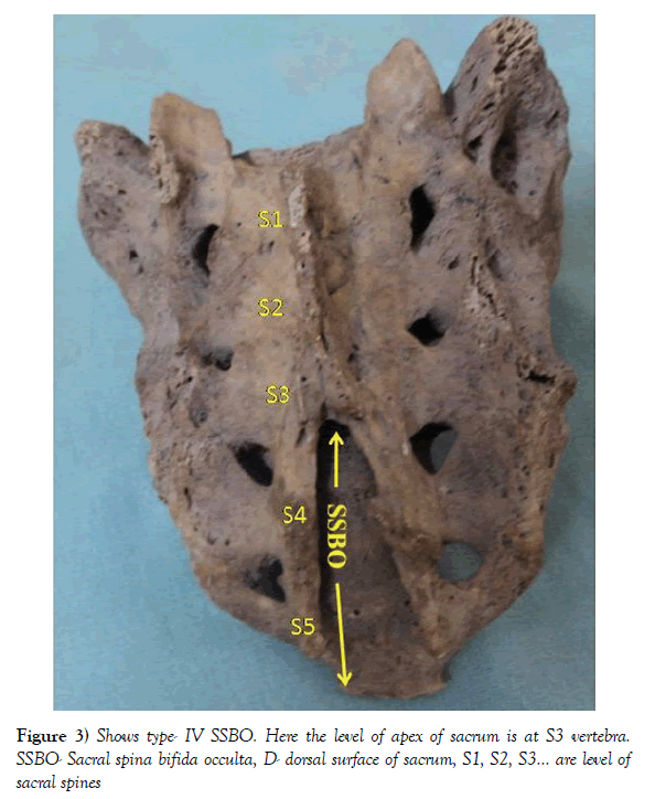 anatomical-variations-surface-sacrum