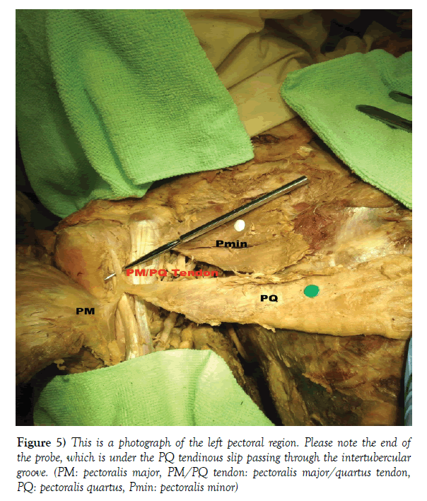 anatomical-variations-tendinous-slip