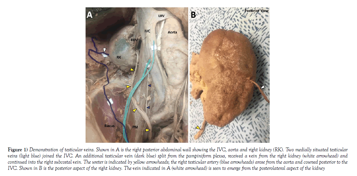 Testicular and scrotal conditions: Pathology review | Osmosis