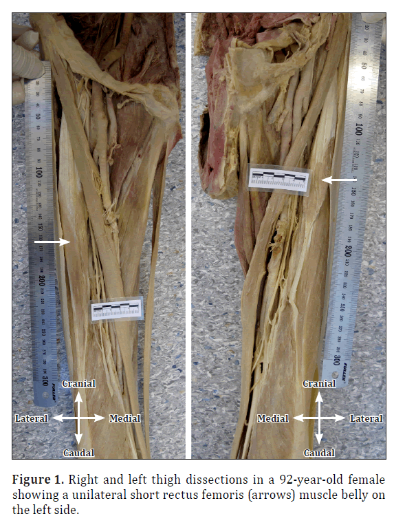 anatomical-variations-thigh-dissections