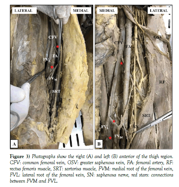 anatomical-variations-thigh-region