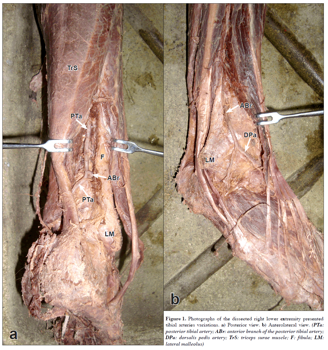 anatomical-variations-tibial-arteries