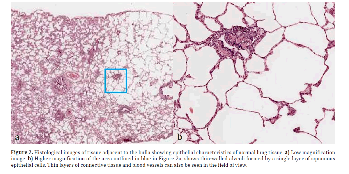 Bullous emphysema – an incidental observation during 