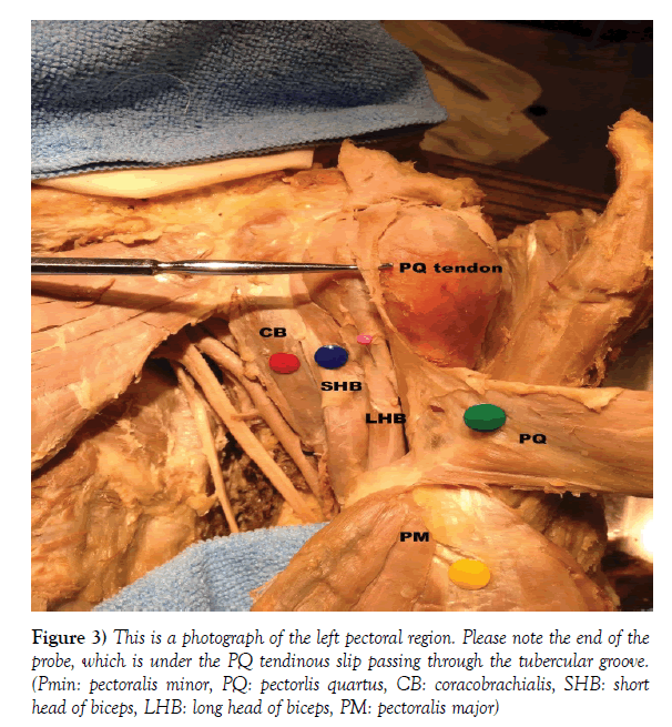 anatomical-variations-tubercular-groove