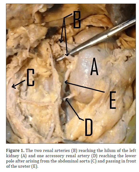 anatomical-variations-two-renal