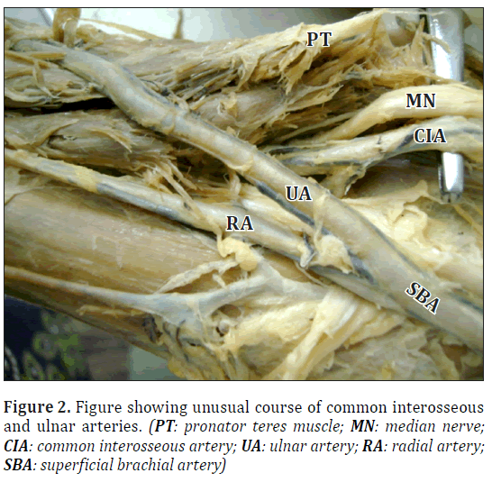 anatomical-variations-ulnar-arteries