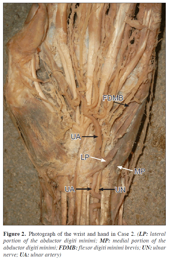 anatomical-variations-ulnar-artery