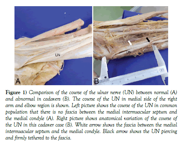 anatomical-variations-ulnar-nerve
