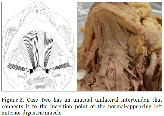 anatomical-variations-unilateral-intertendon