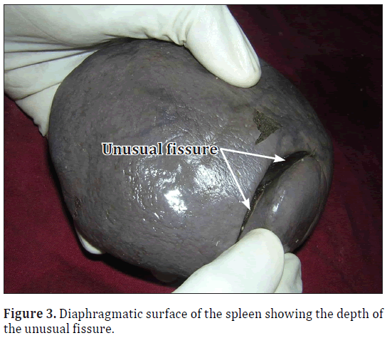 anatomical-variations-unusual-fissure