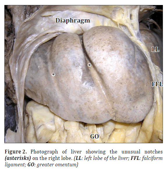 anatomical-variations-unusual-notches