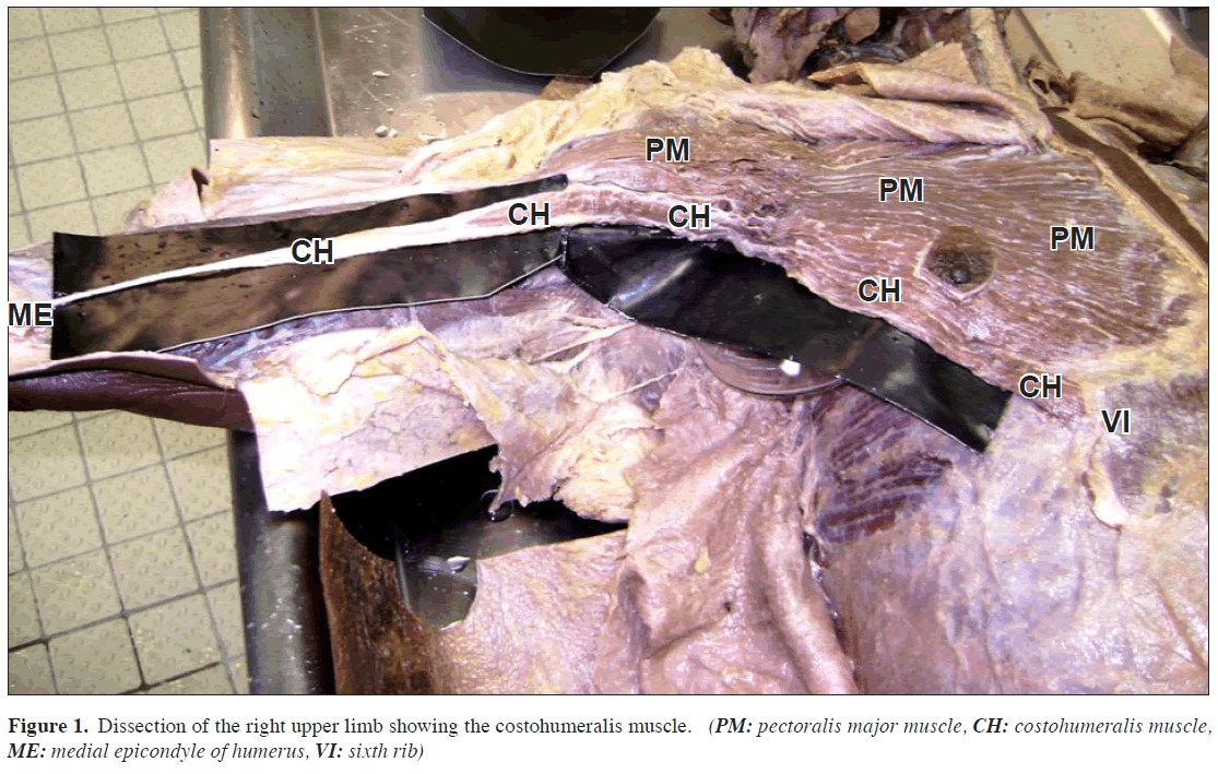 anatomical-variations-upper-limb
