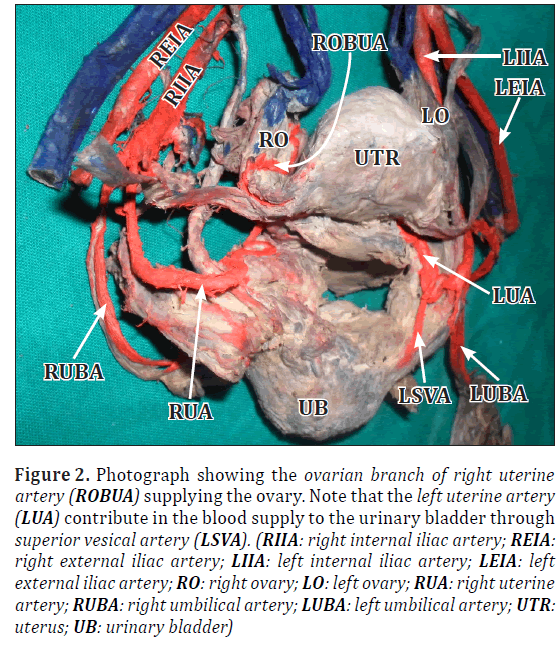 anatomical-variations-urinary-bladder