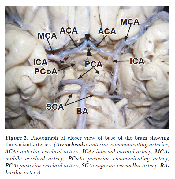 anatomical-variations-variant-arteries