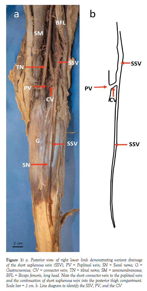 anatomical-variations-variant-drainage